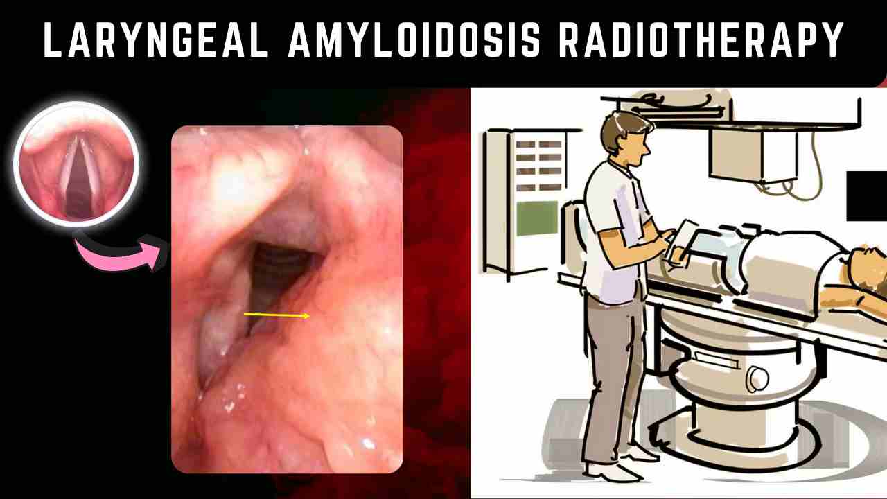Laryngeal Amyloidosis Radiotherapy