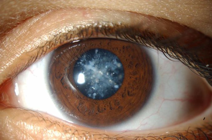 Blue Dot Cataract Everything You Need To Know