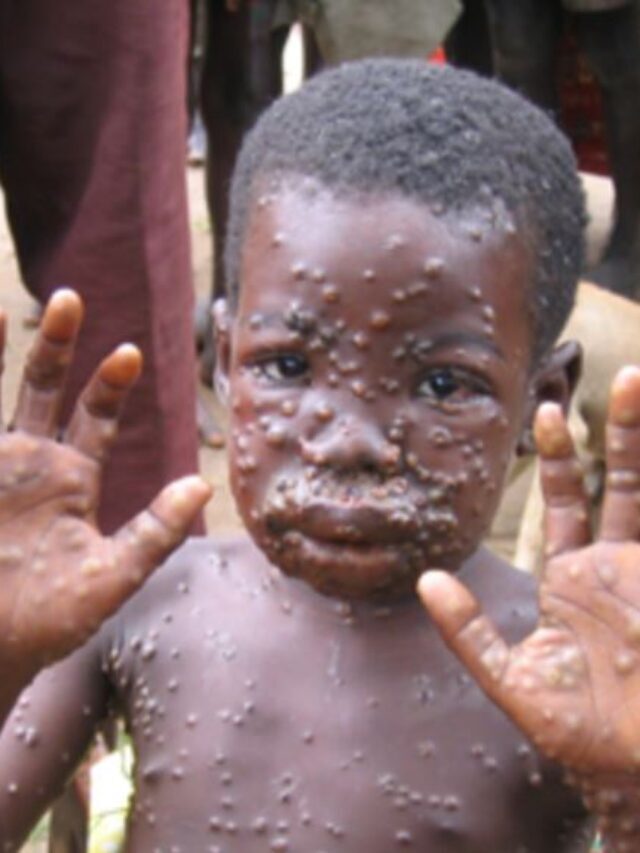10 things you should know about Monkeypox