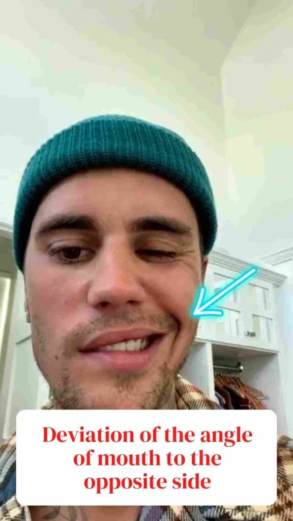 Ramsay Hunt syndrome Justin bieber symtoms
