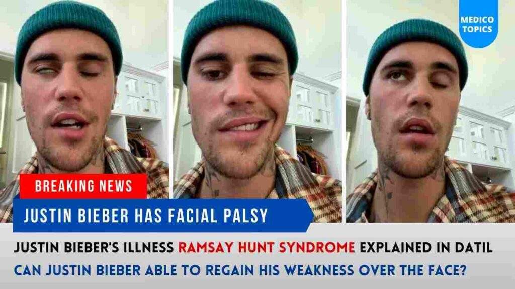 What is Ramsay Hunt syndrome? Justin Bieber's Illness Explained in Detail