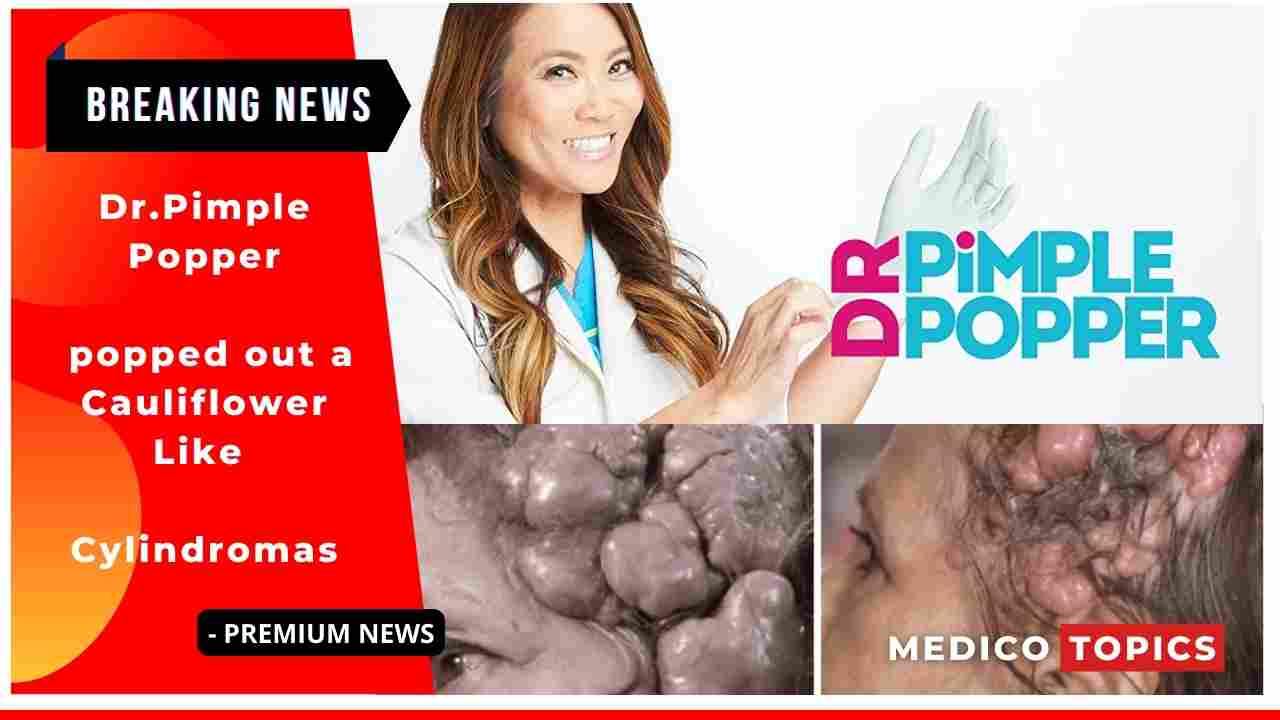 Dr Pimple Popper popped out a Cauliflower-Like Cylindromas
