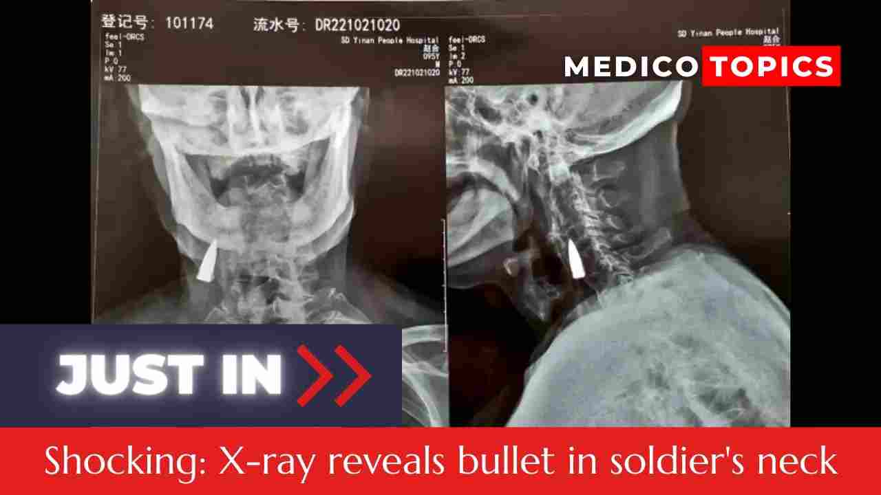 X-ray reveals bullet lodged in army vetaran's neck for 77 years